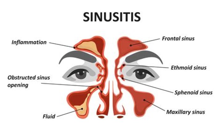 Can ethmoid sinusitis cause eye pain?